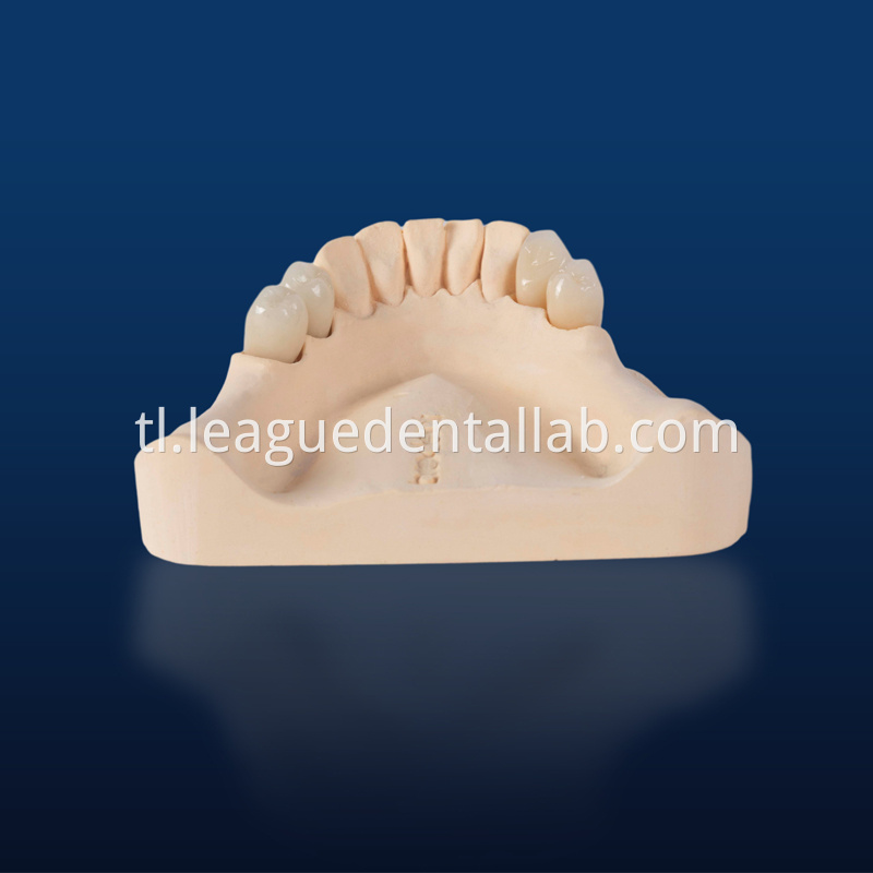 PFZ,Porcelain Fused to Zirconia,Zirconia Layered, Zirconia Veneered
